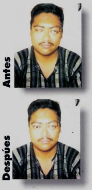 ocularista Guillen Avisos gratis en Mexico lindo en Azcapotzalco |  adaptacion y fabricacio de protesis oculares electronica, PROTESIS OCULARES CON  MOVIMIENTO