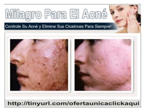 vick Avisos gratis en Mexico lindo en Texcoco |  Como Quitar Barros y Espinillas R&aacute;pidamente, Elimina tu acn&eacute; en tan s&oacute;lo 2 semanas